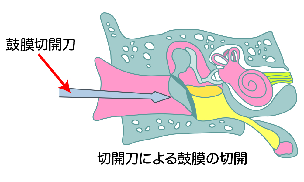 急性中耳炎の治療