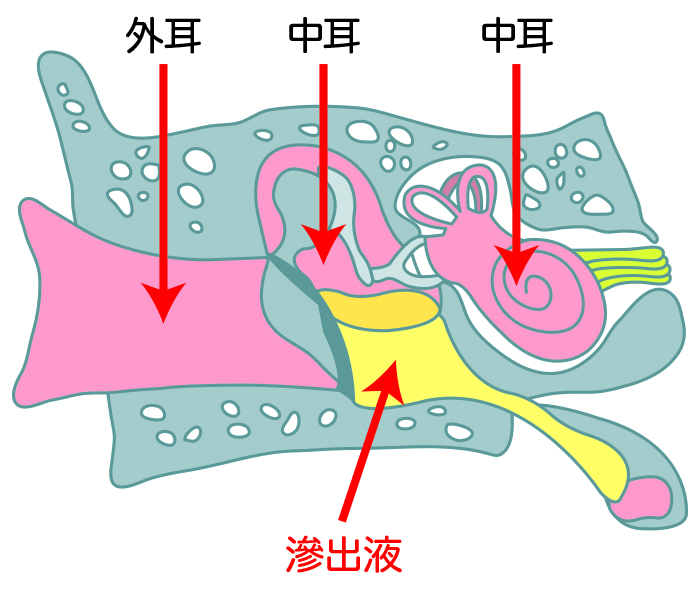 滲出液が耳の奥にたまる滲出性中耳炎