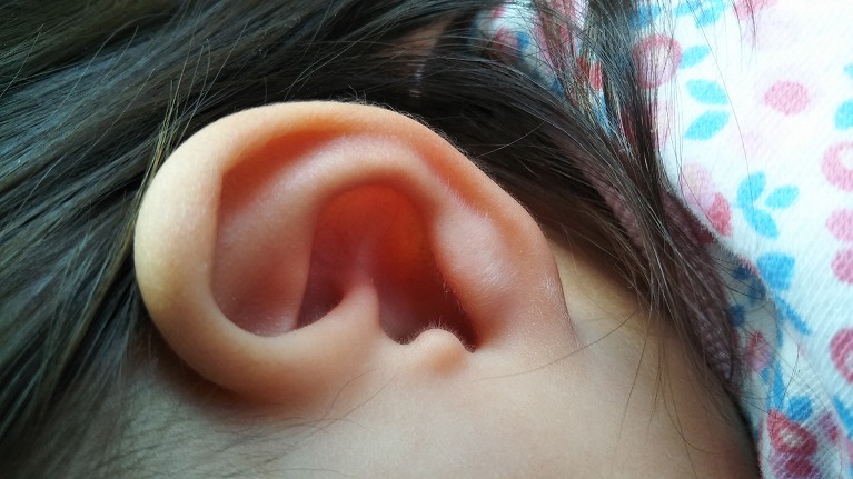 急性中耳炎で耳が痛くなることがあります